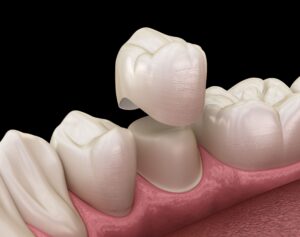 Illustration of dental crown above a prepared tooth