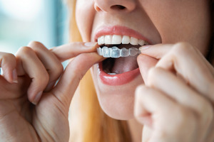 Woman putting in an Invisalign aligner