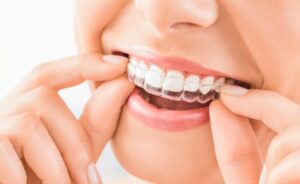Invisalign clear aligner being fitted onto top teeth.