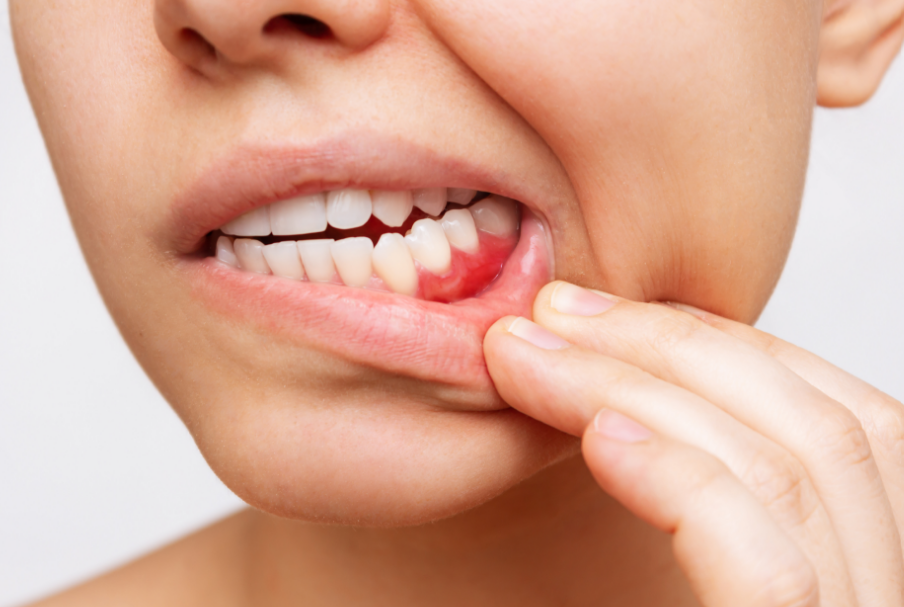 Woman with inflammed gums